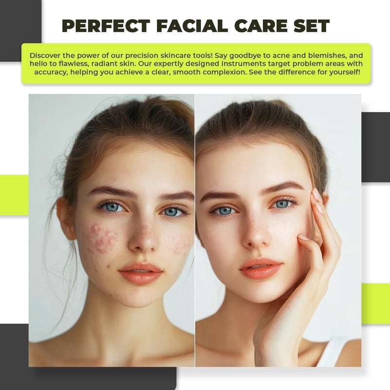 DERMATED [6 Pcs] Blackhead Remover Tools for Acne - Surgical Stainless Steel Pimple Popper Tool Kit, Comedones & Blemish Extraction Kit - Image 5